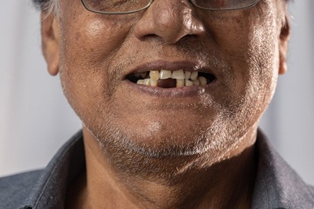 Man has lost a few teeth