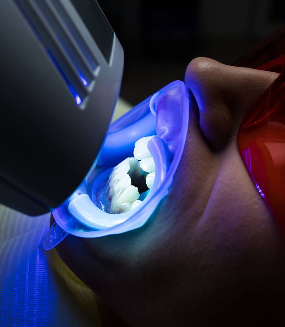 In-office teeth whitening