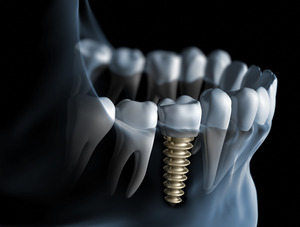 Render of dental implant in the lower jaw