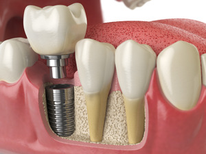 Picture of dental implants